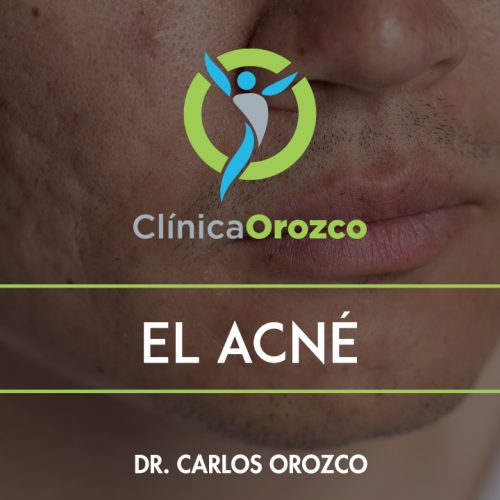 Clinica Orozco - El Acné. Medicina Natural