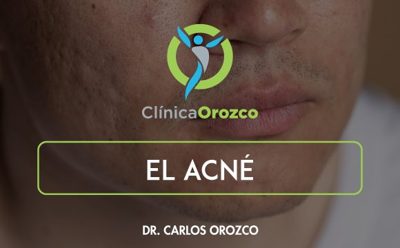 Clinica Orozco - El Acné. Medicina Natural